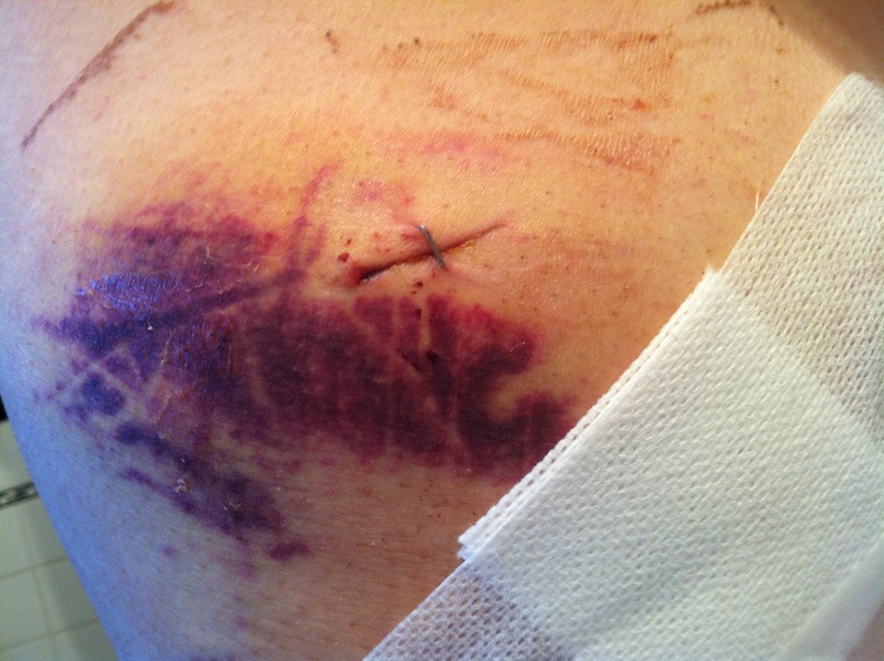 stabwound.jpg